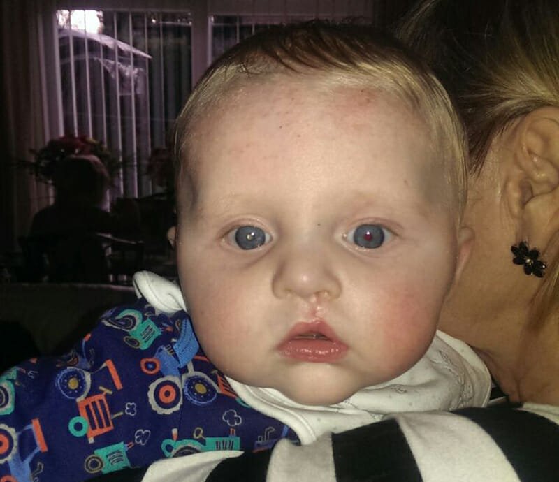 CHECT Photo - photo of Ethan at five months which shows the white glow