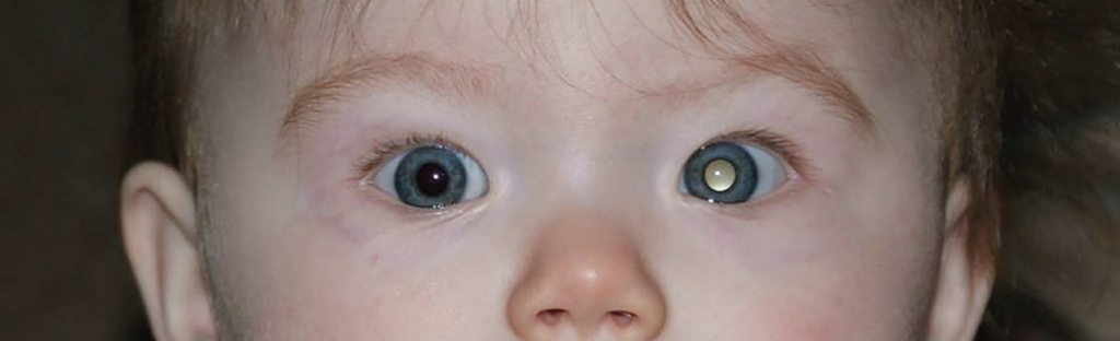 Socket Problems Post Enucleation Childhood Eye Cancer Trust