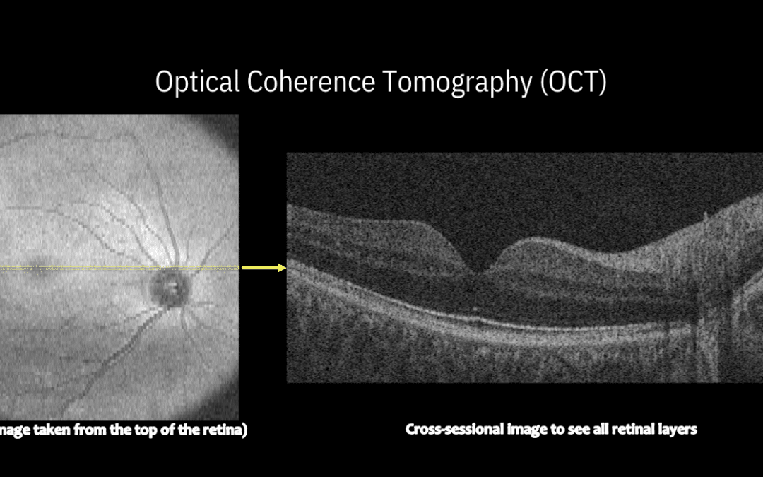 How an OCT scan can impact retinoblastoma treatment plans
