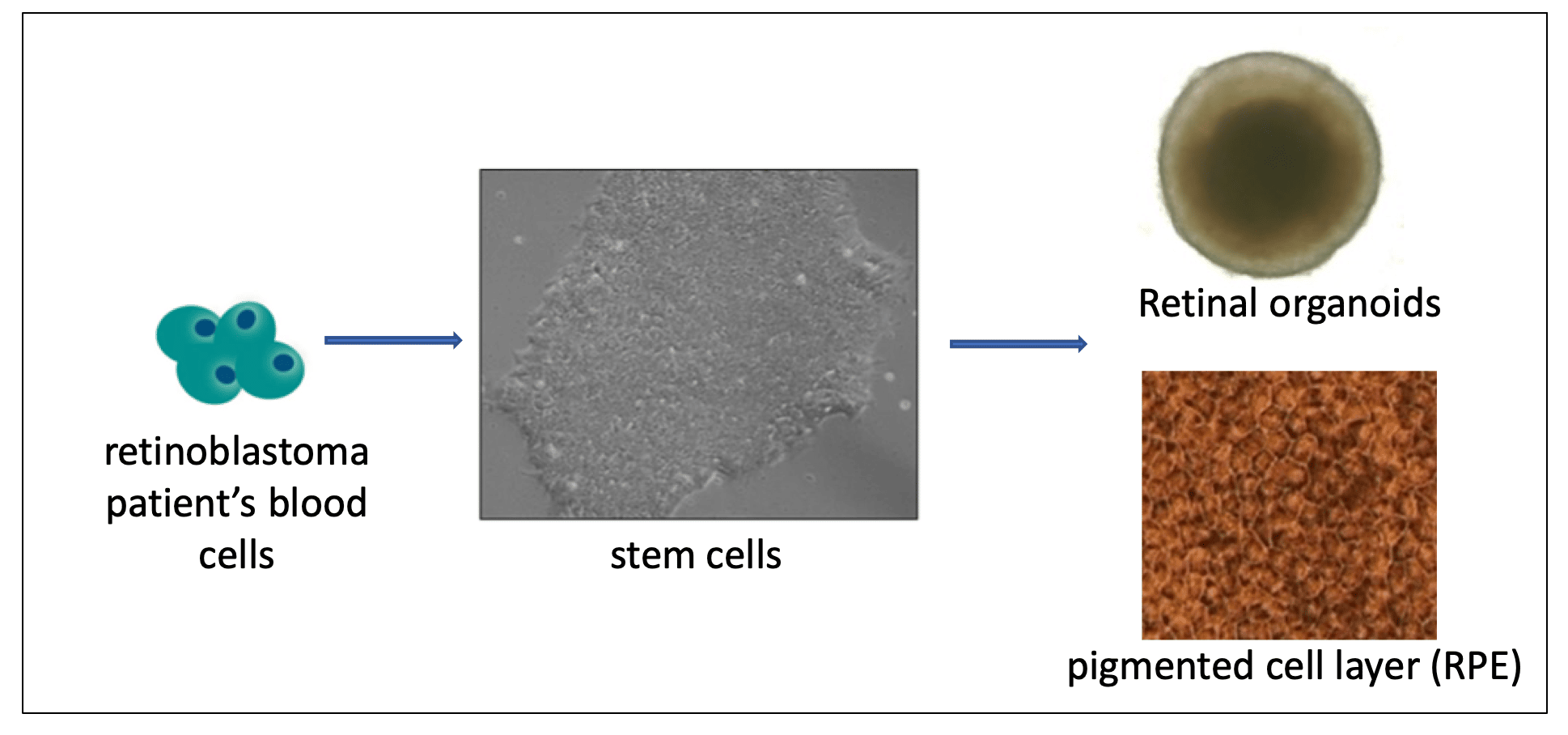 The graph shows a retinoblastoma patient's blood cells, then stem cells, then retinal organoids and pigmented cell layer (RPE)
