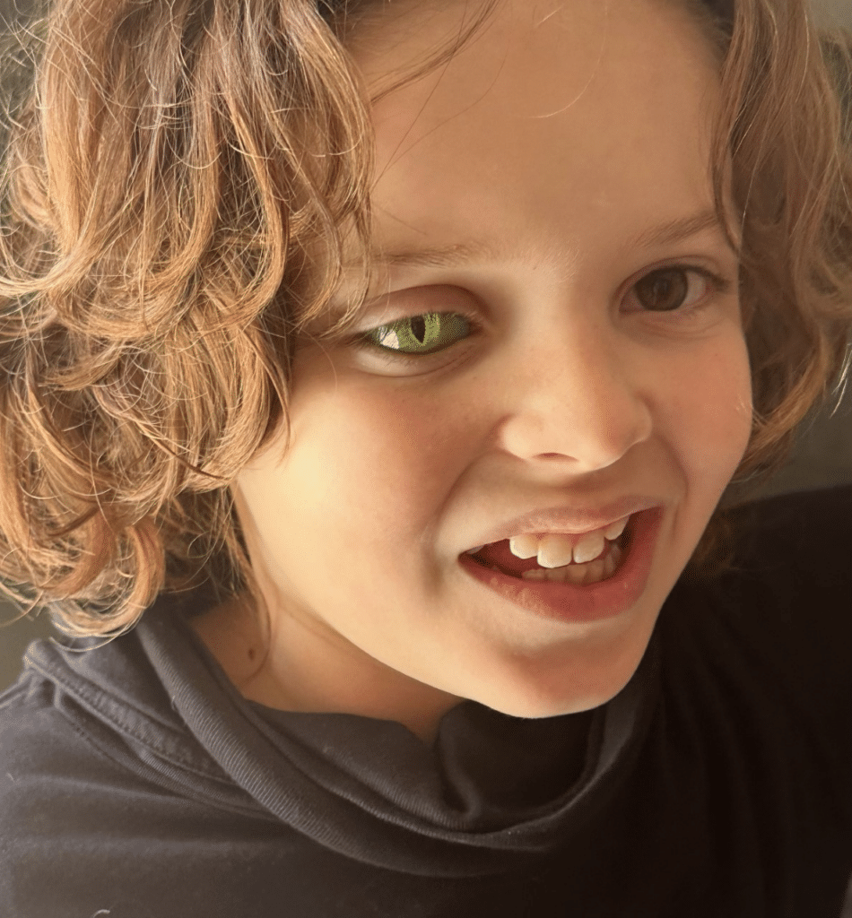 Jude's customised prosthetic eye - one is green and one is brown