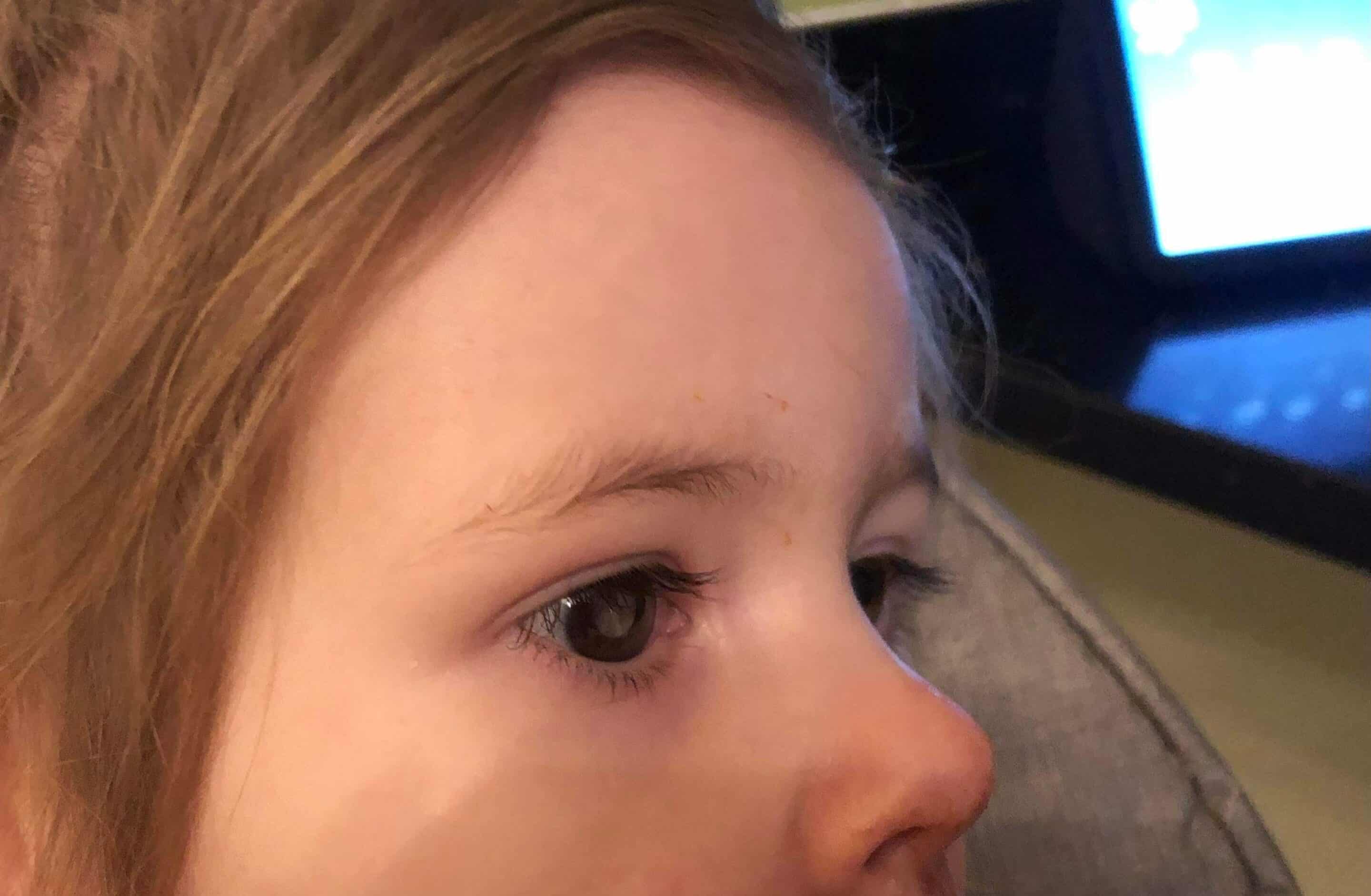 “my Daughters Optometrist Aunt Referred Her For Retinoblastoma