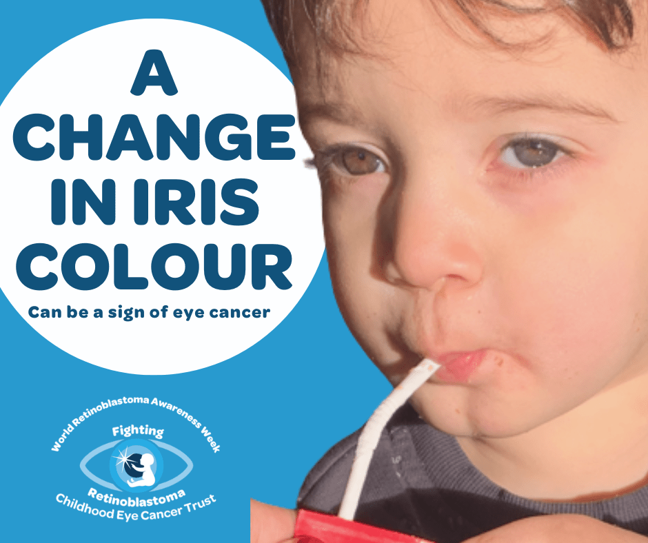 text reads a change in iris colour can be a sign of childhood eye cancer