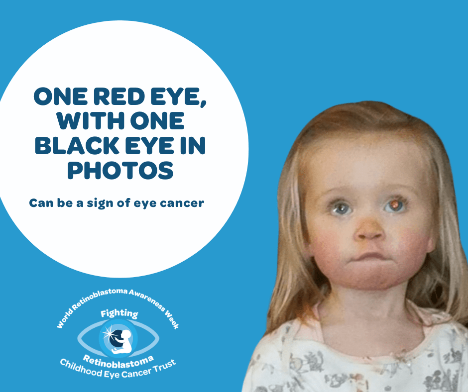 the text reads The absence of a red eye in a photo (where flash has been used and one eye has red eye) can be a sign of childhood eye cancer